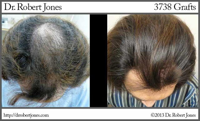 Brilliant example of a restoration of the crown!