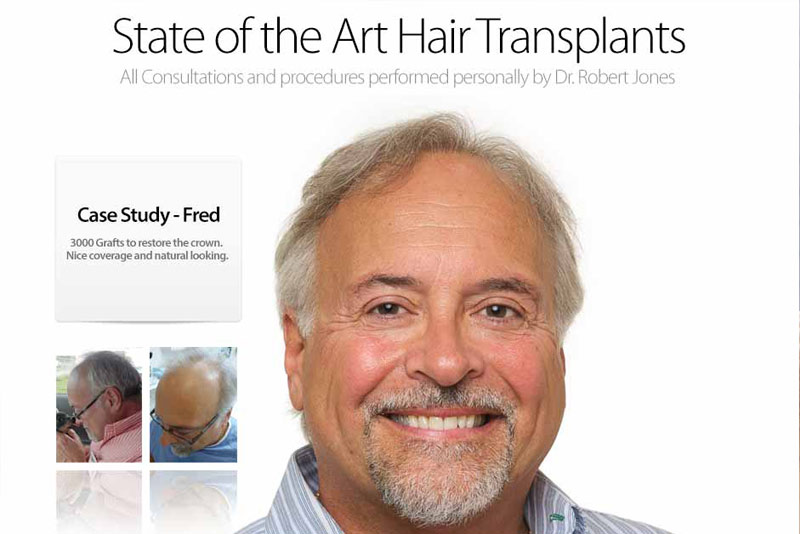 Patient Infographic – Complete Patient Timeline – Hair Transplant Start to Finish