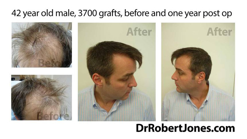 42 Year Old Male – 3700 Grafts – 1 Year Post Operative