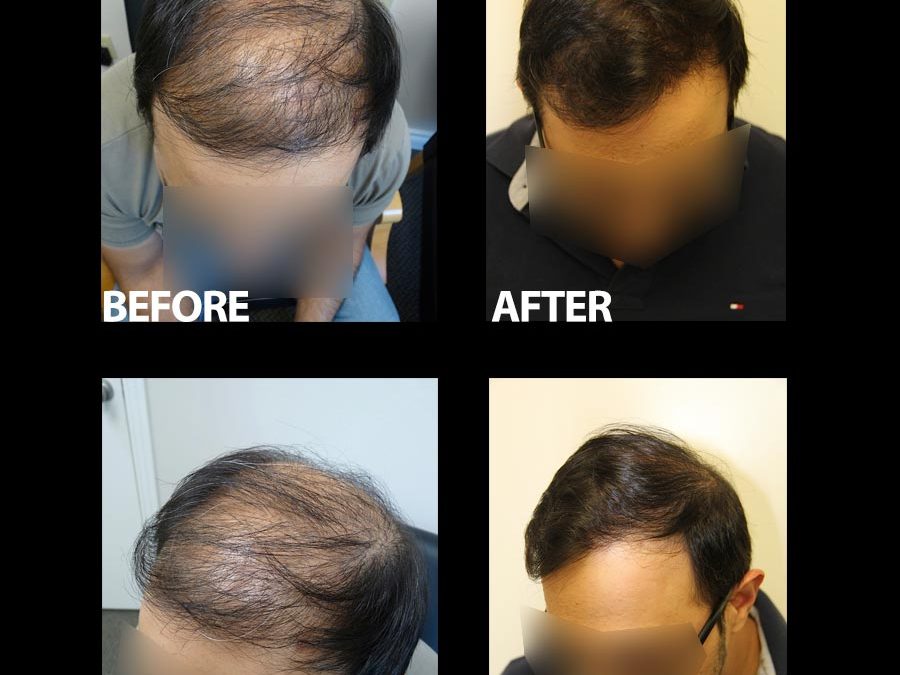 3500 Grafts – Another Great Result From The Team At DrRobertJones.com