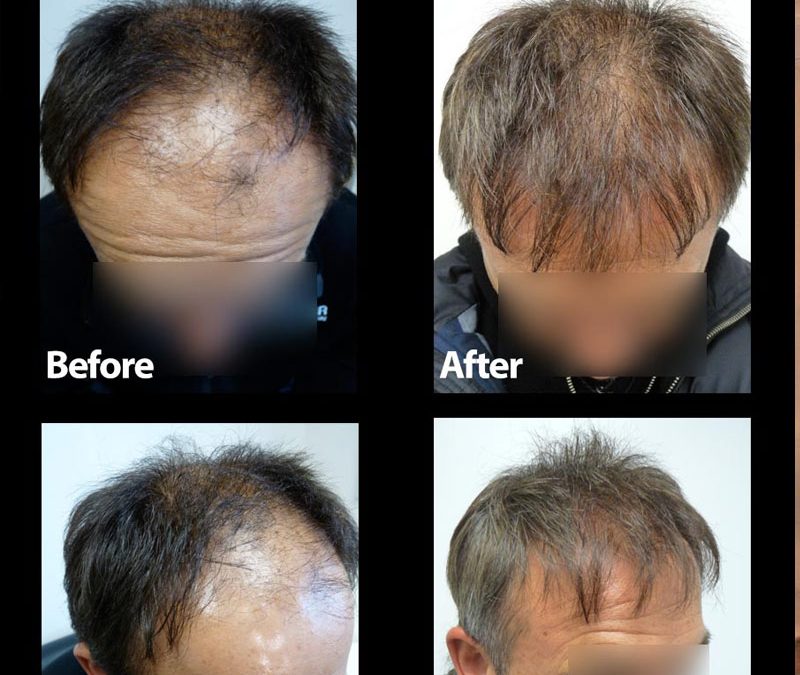 3500 Graft Strip Surgery – Before and After – Video Case Study