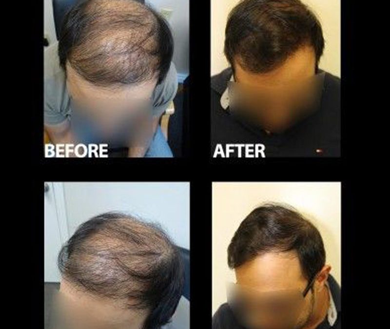 Dr.Jones’ FUE – Five Great Recent Cases