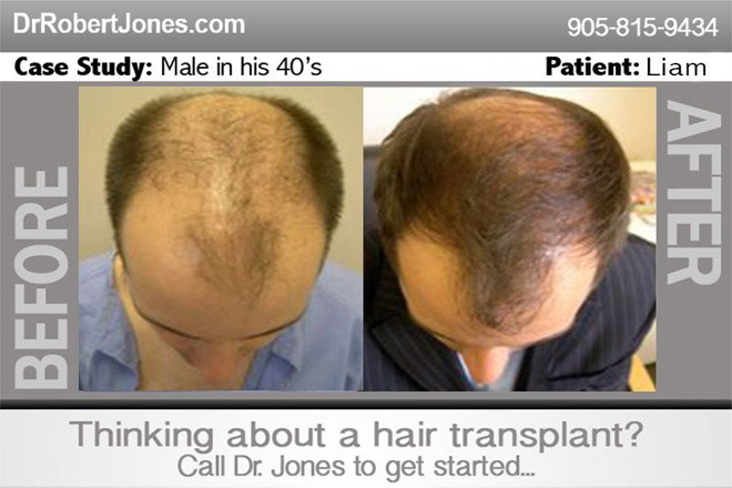 Female Hair Transplant