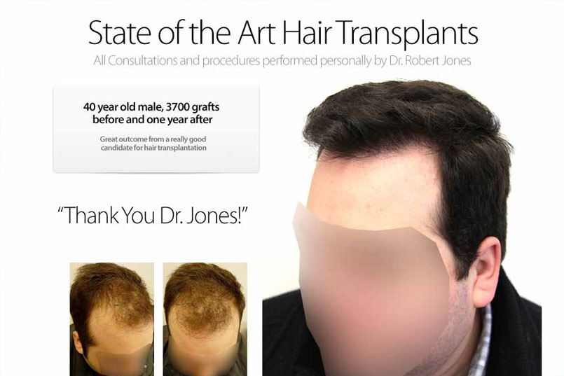 Hair Transplant Case Study – 40 Year Old Male – 3700 Grafts – 1 Year Post Operative