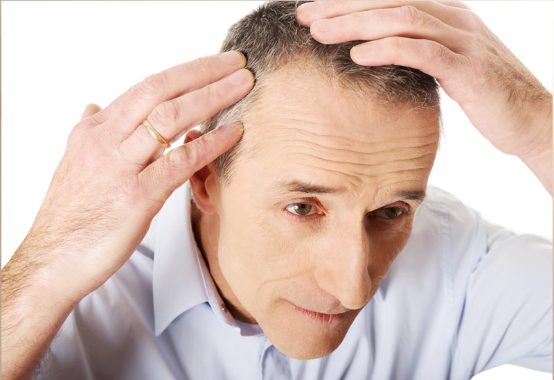 FUE Transplant – Amazing coverage of crown!