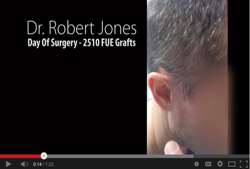 Day Of Surgery – Video Case Study – 2510 Grafts FUE