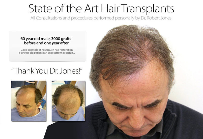 New Case Study – Hair Transplant On 60 Year Old Male