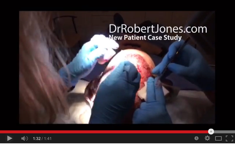 Tell Your Story Hair Transplant – Day of Surgery – FEB 2014