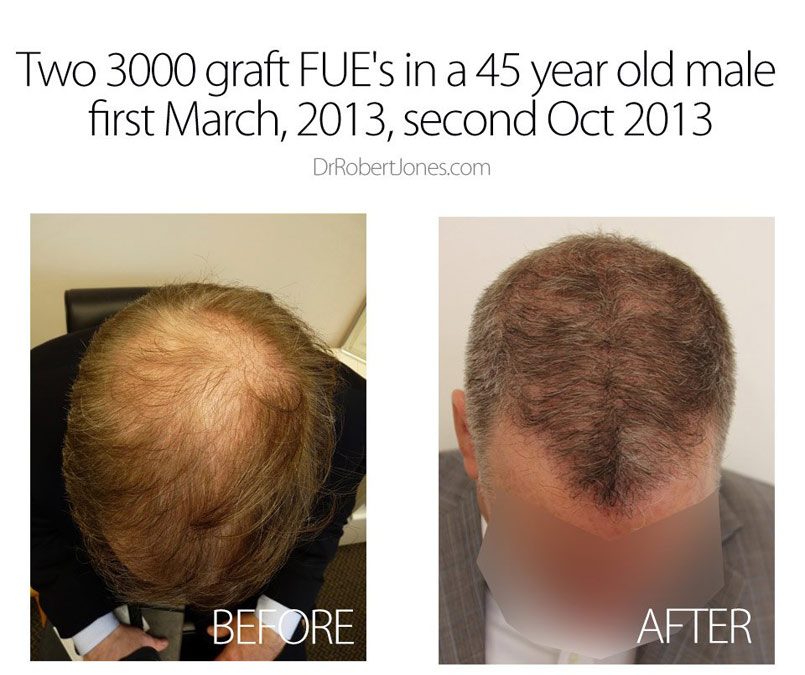 Two 3000 graft FUE in a 45 year old male