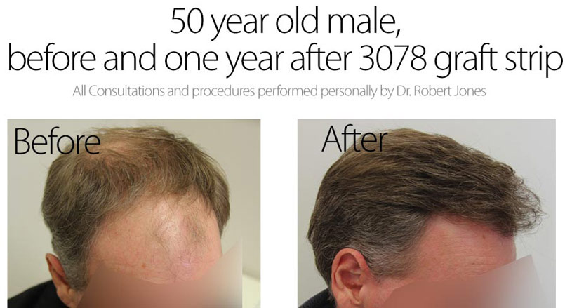 50 Year Old Male – 3078 Graft Strip Surgery – 1 Year Post Op