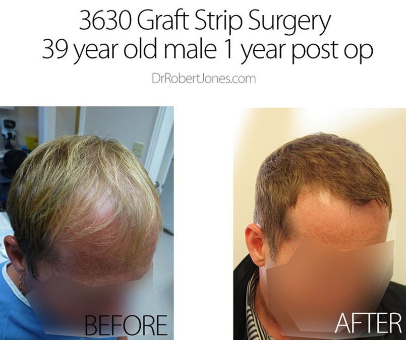 3630 Graft Strip Surgery – 39 Year Old Male – 1 Year Post Op