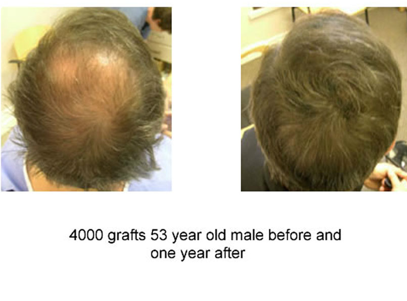Very impressive 4000 grafts procedures performed by Dr.Jones!