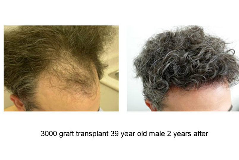 Amazing results from 3000 graft procedures performed by Dr.Jones!