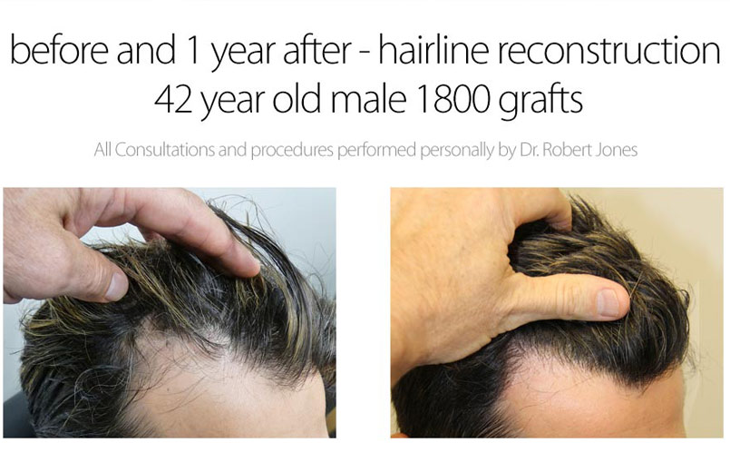 1800 Graft Hairline Reconstruction