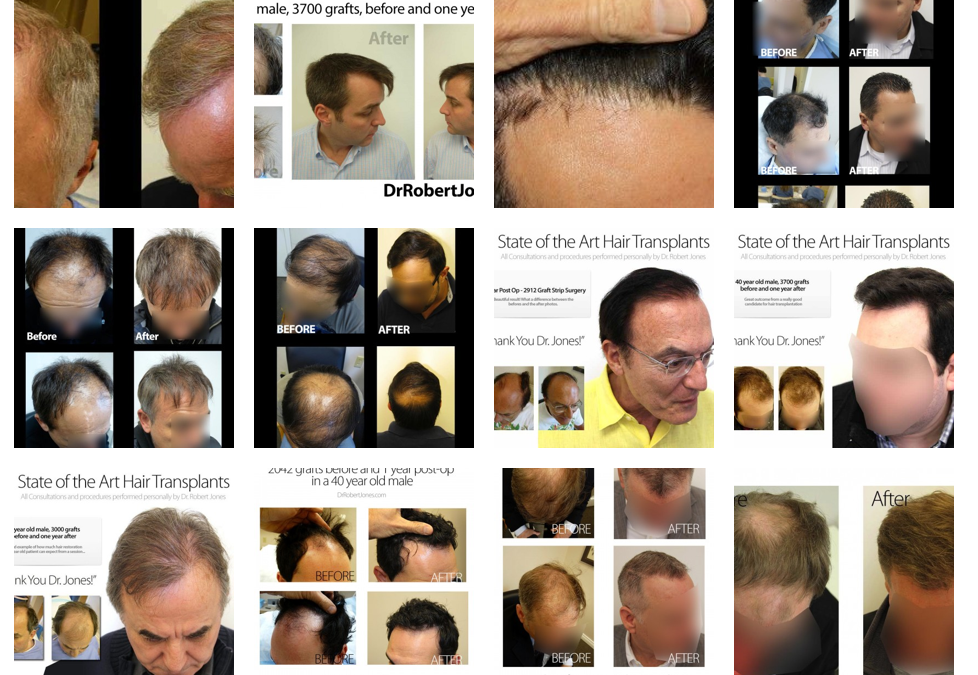 2014 Before And After Gallery Update – Sort By Age, # of Grafts and More –