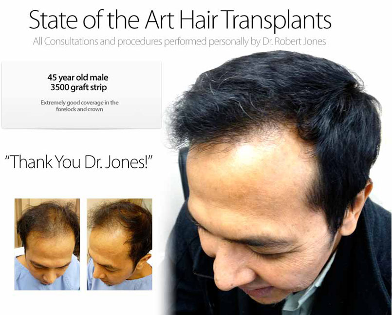 CASE STUDY: 3500 Graft Strip Surgery – 40 Year Old Male