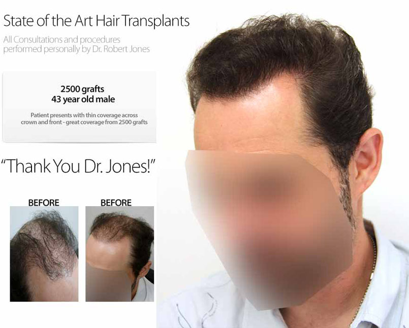 2500 grafts – 43 Year Old Male – Video Case Study