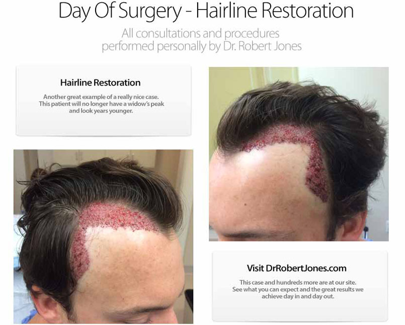 Hairline Restoration