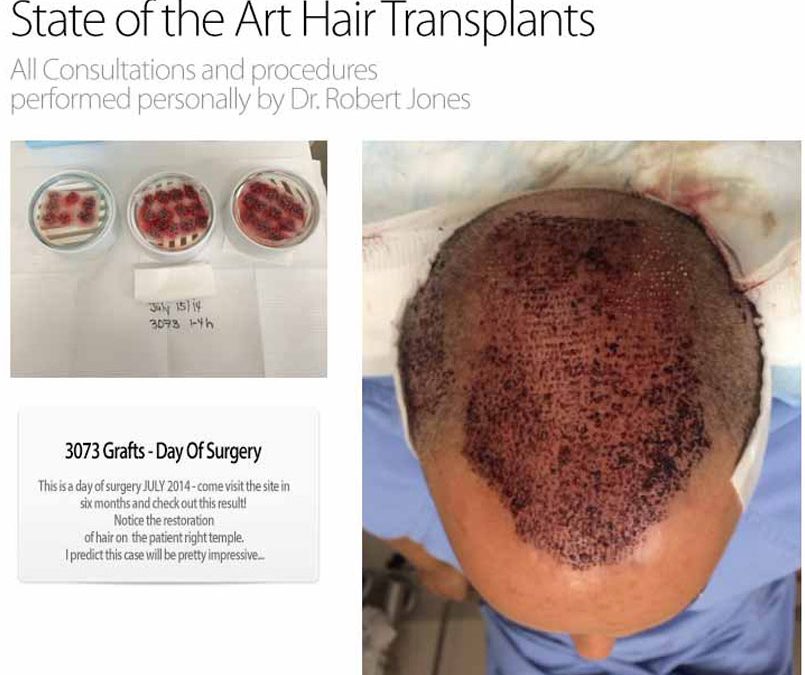 Day Of Surgery – 3000 Graft FUE Case