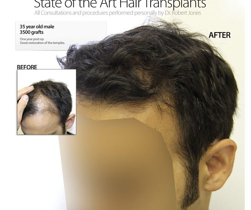 VIDEO – 3500 Graft Hair Transplant – 35 Year Old Male – 6 Months Post Op