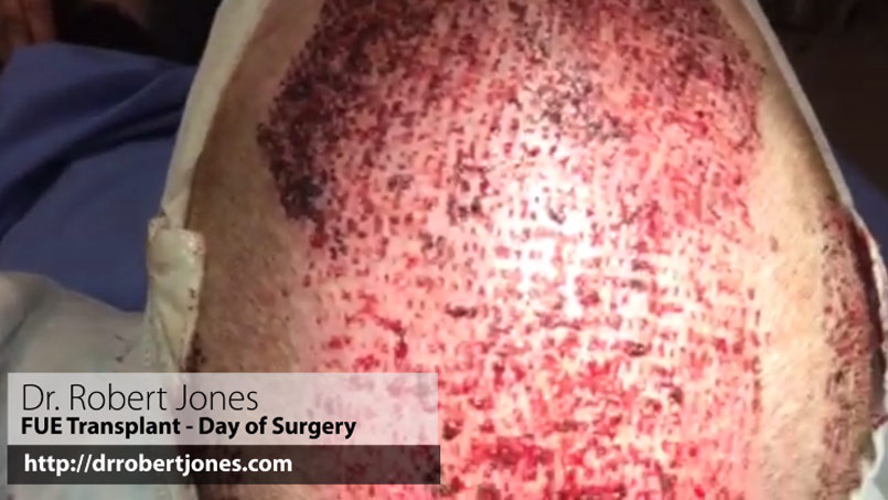 VIDEO – 3500 FUE Day of Surgery