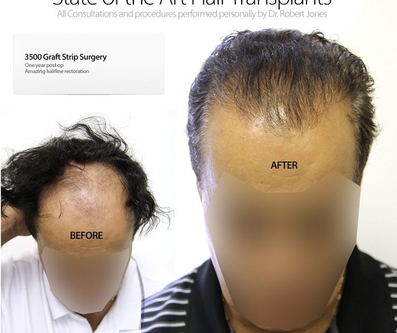 3500 Graft Strip Surgery – Hairline Restoration
