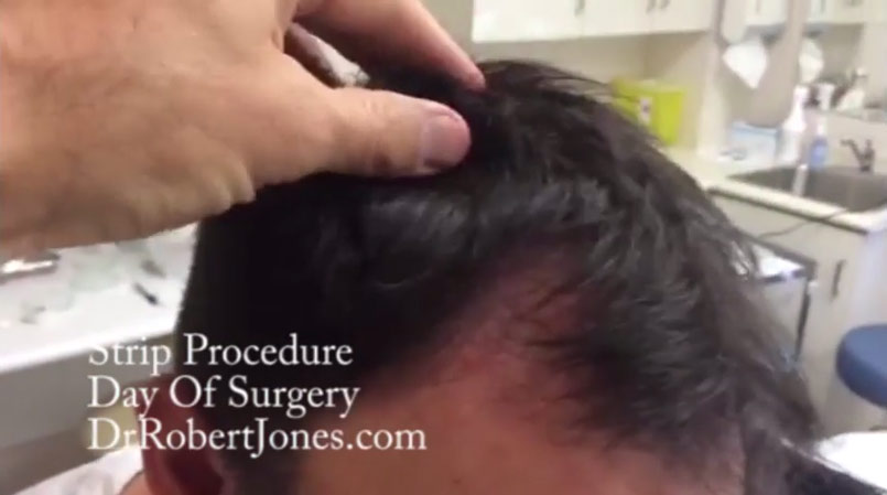STRIP Hair Transplant – Day Of Surgery – Video Case Study