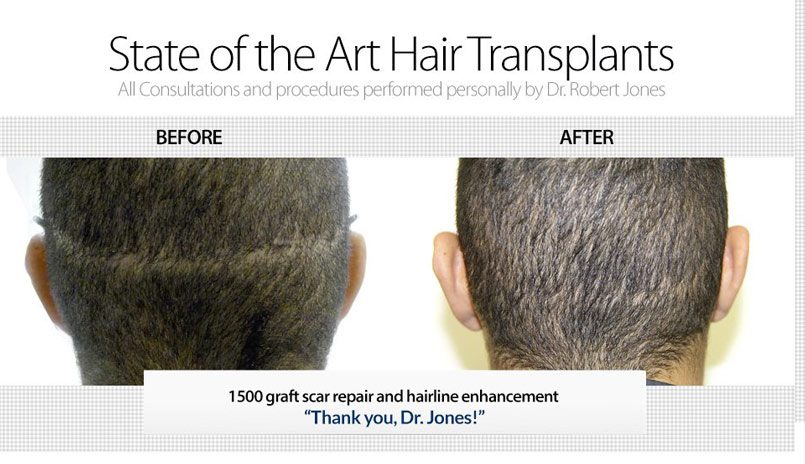1500 Grafts To Repair Old Hair Transplant Scar and Rebuild Hairline