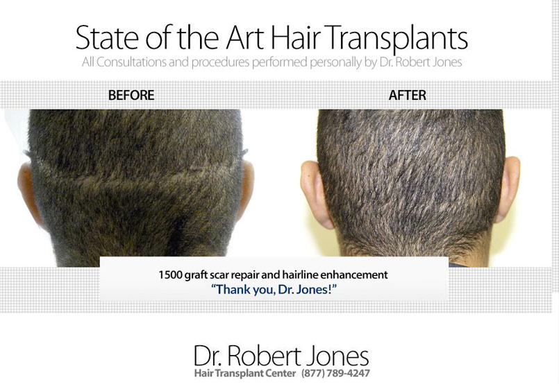 1500 Grafts To Repair Old Hair Transplant Scar and Rebuild Hairline