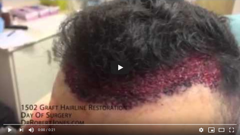 VIDEO – What To Expect – Day Of Surgery – 1505 Grafts – Hairline Restoration