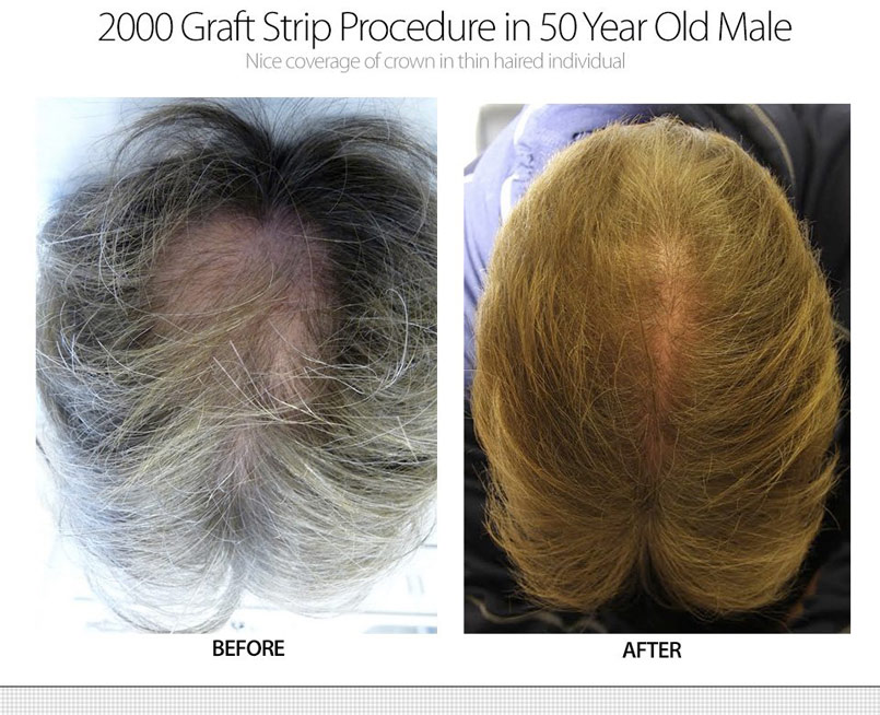 2000 Graft Strip Surgery – 50 Year Old Male – Crown Restoration