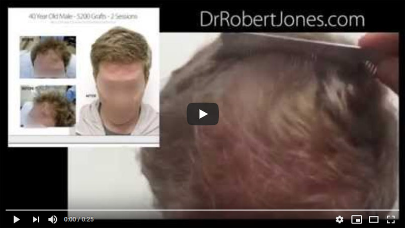 VIDEO CASE STUDY – 5200 Graft Hair Transplant – 40 Year Old Male – 2 Sessions