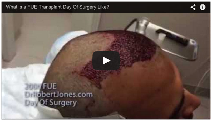Day Of Surgery – 2000 Graft FUE Hair Transplant – Video Case Study