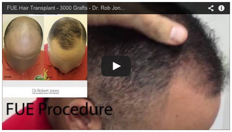 3000 Graft FUE – Video Case Study