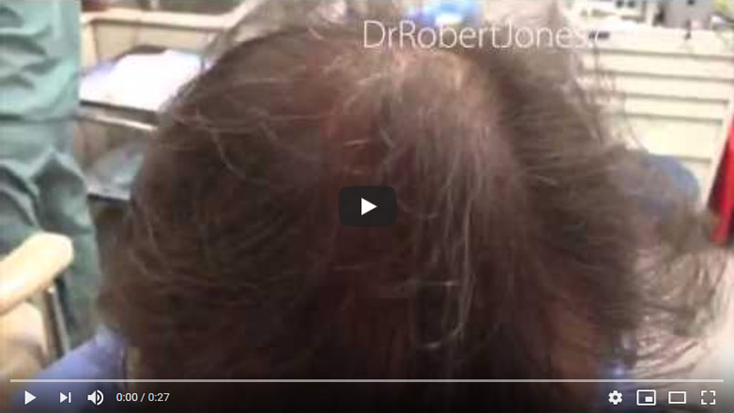 3000 Graft FUE – 1 Year Post Operative