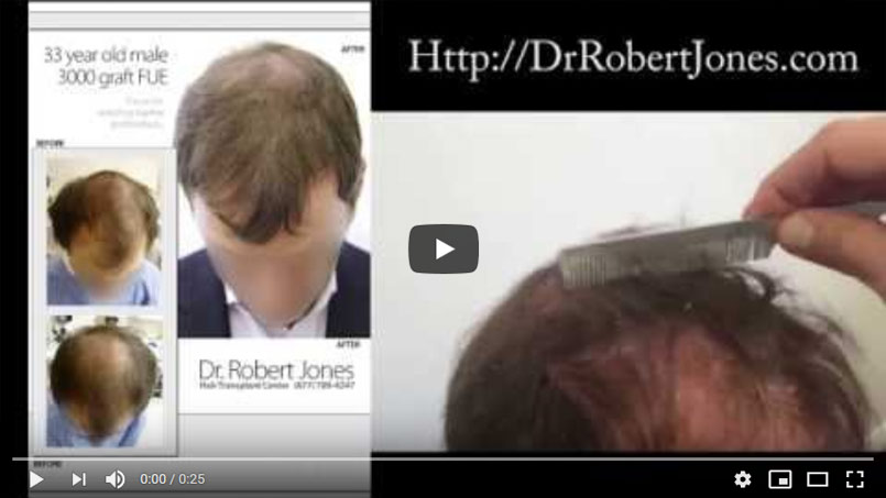 33 Year Old Male – 3000 Graft FUE – Restoration of temples/crown/forelock