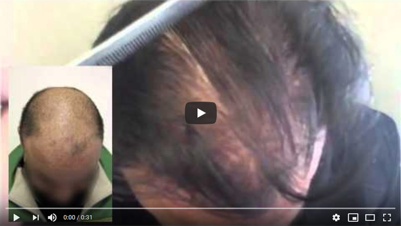 VIDEO CASE STUDY – 4200 Graft Strip Surgery