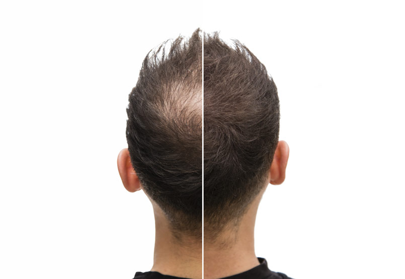 3000-3500 Graft Cases – Patient Gallery