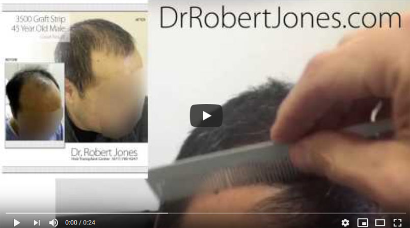 VIDEO CASE STUDY – 3500 Graft Strip Hair Transplant – Toronto CA