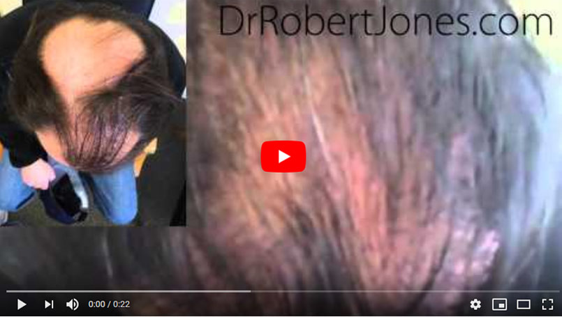 3700 Graft Strip – VIDEO CASE STUDY – 1 Year Post Op