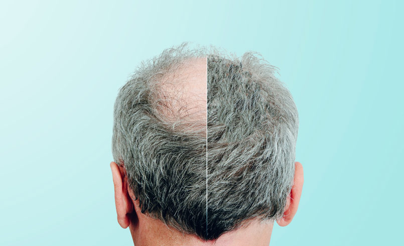 4000 Graft Strip Surgery – Amazing 5 Month Result!