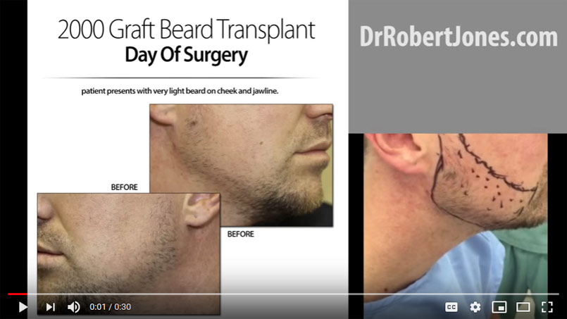 VIDEO – 2000 Graft Beard Transplant – Day Of Surgery