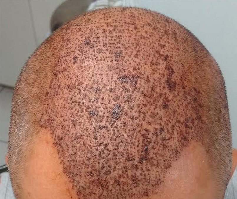 3000 Graft FUE – DAY 2 – CASE STUDY