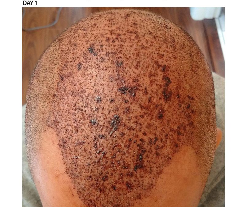 3000 Graft FUE – DAY 1 – CASE STUDY