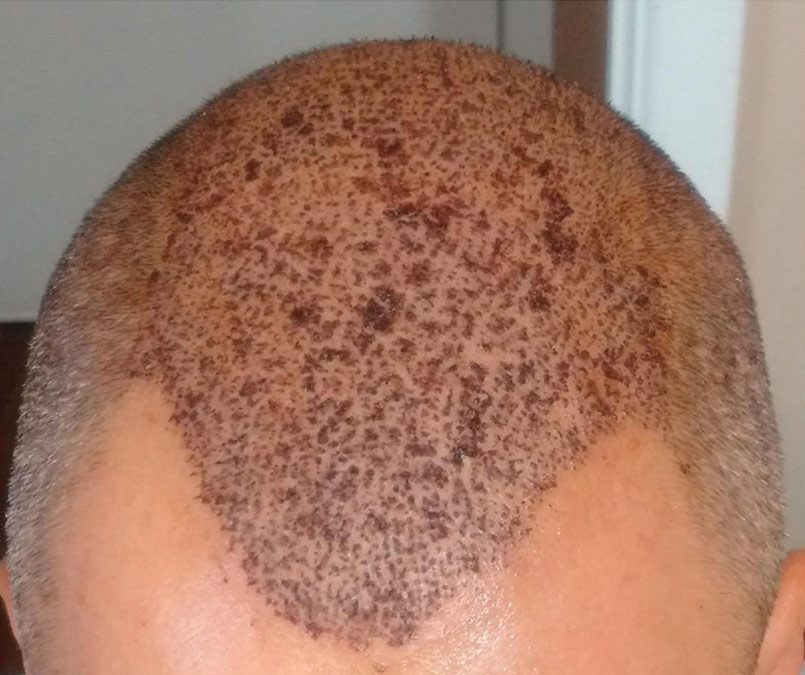3000 Graft FUE – DAY 3 – CASE STUDY