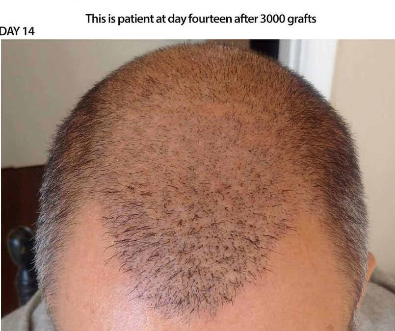 3000 Graft FUE – DAY 14 – CASE STUDY