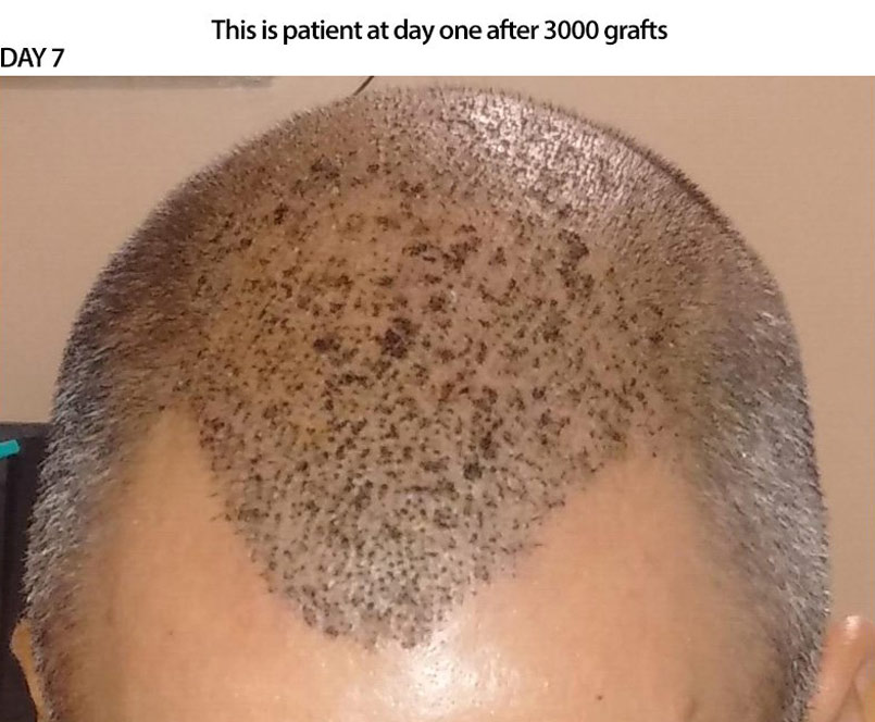 3000 Graft FUE – CASE STUDY – Day 7