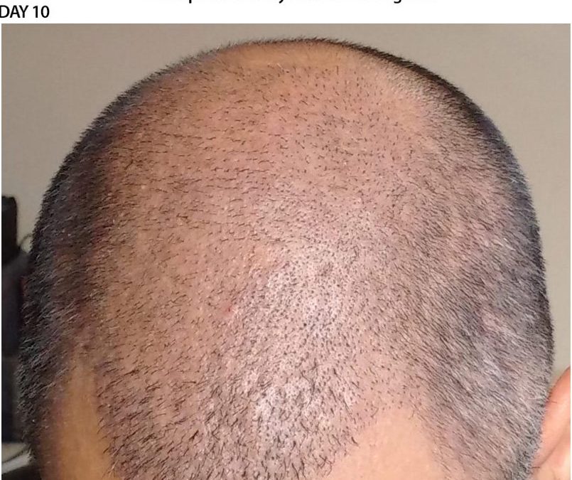3000 Graft FUE – DAY 10 – CASE STUDY