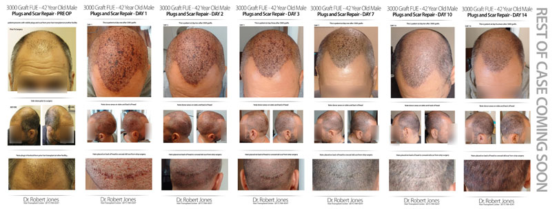 3000 FUE Timeline – DAYS 1 – 14 – CASE STUDY
