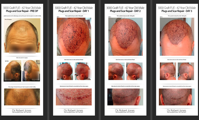3000 Graft FUE – First 4 Days – CASE STUDY